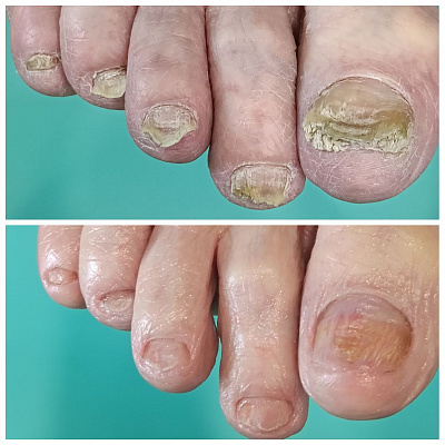 Дистрофические изменения ногтей: онихолизис, онихомикоз, онихогрифоз – профессиональные методы обработки.